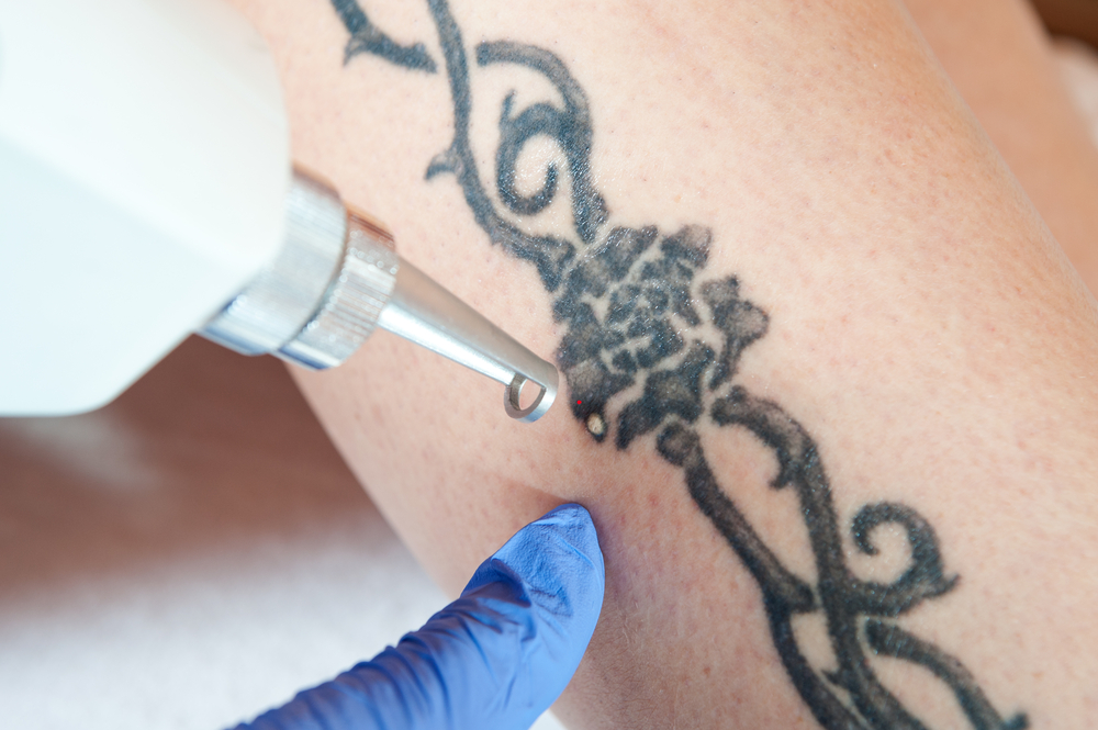 Laser Tattoo Removal  Birmingham Homewood  Chelsea AL